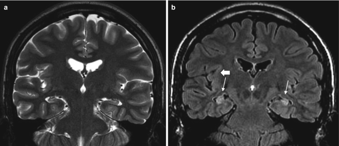 2 radiological scans of the brain. 1. Coronal T 2 M R I scan presents atrophy of both hippocampus. 2. Coronal F L A I R scan. Arrows mark hyperintensity in the hippocampus.