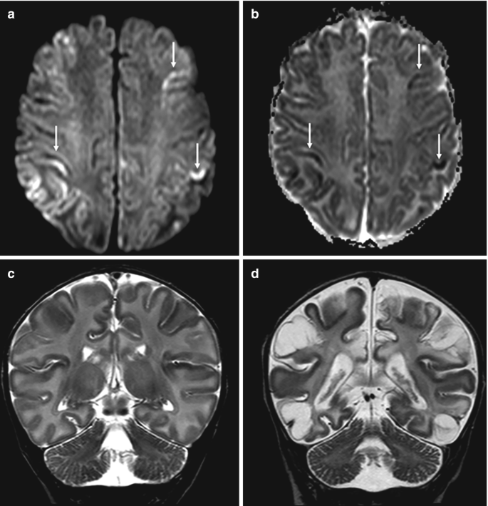 4 parts. a and b. An axial M R I and an A D C map exhibit gray matter in both hemispheres. c and d. Two coronal M R I scans of the brain are exhibited. The latter portrays prominent structural changes.
