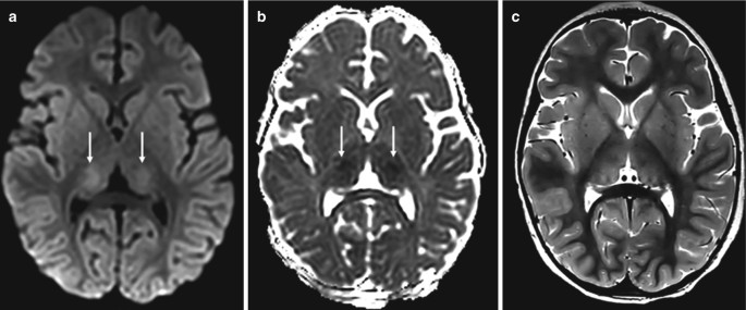 2 axial M R I scans and a A D C map of the brain present the left and right thalamus.