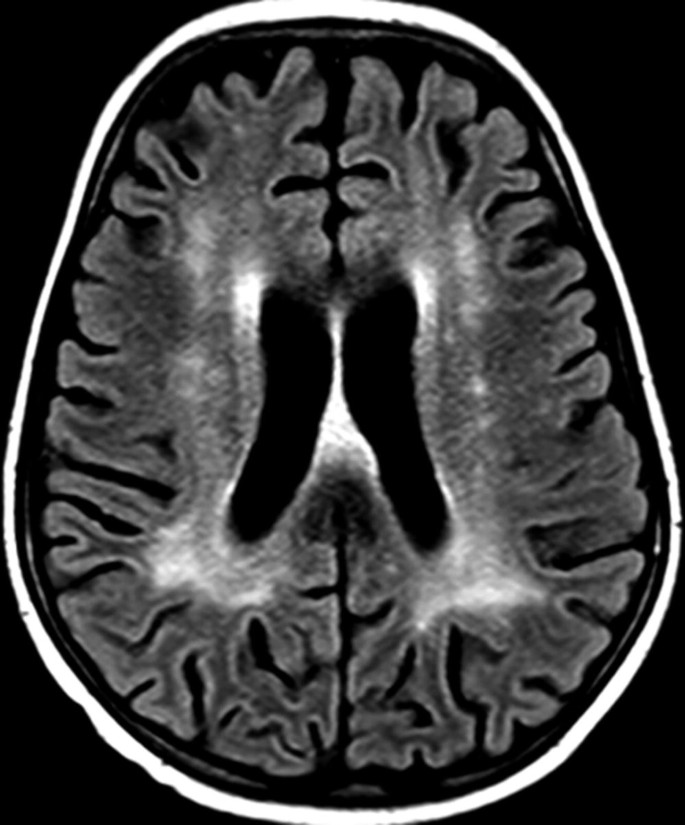 An axial F L A I R scan of the brain portrays evident structural changes in the white matter.