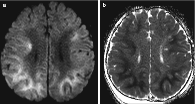 An axial M R I and an A D C map of the brain. In the former, the white matter is exposed.