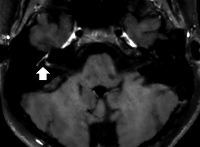 An axial M R I scan of the face. An arrow indicated the slender and light-shaded right facial nerve.