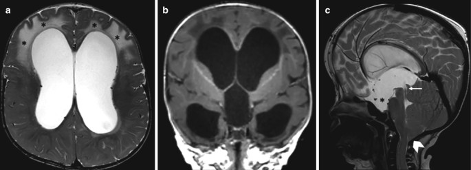 3 M R I scans of the brain. a. The swollen tissues are exhibited in light-shaded, diffused patches within the cerebral ventricles. b. The temporal and frontal hons are exposed in a dark shade. c. The third ventricle is highlighted in a light shade.