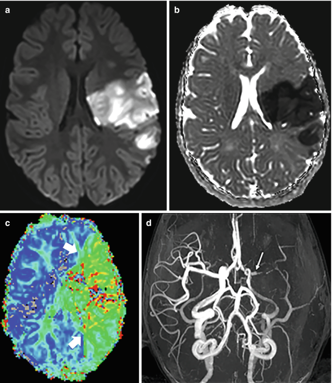 4 parts. a and b. A M R I scan and an A D C map of the human brain are exhibited. c. Perfusion M R I scan with arrows indicating two areas with less blood flow. d. A M R angiogram of the brain portrays a network of arteries.