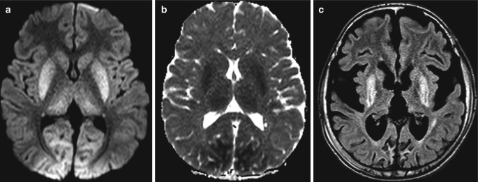 3 cross-sectional M R I scans of the brain. a. and b. The structural changes are not evident. c. The structural changes are evident, indicating the loss of brain cells.