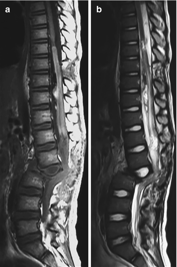2 M R I scans of the spinal cord. The vertebral body appears to be deformed in both scans.