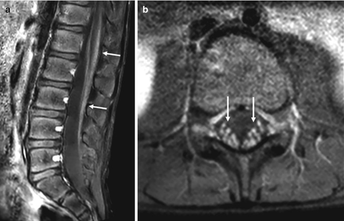 2 M R I scans of the spinal cord in two views. The cauda equina nerves appear thick, as indicated by arrows in a dark shade.