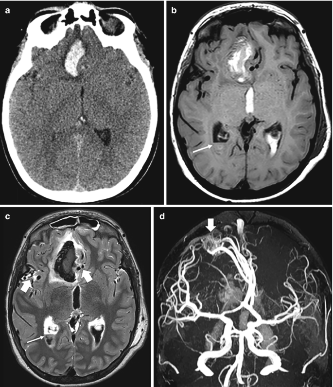 4 parts. a, b, and c. 3 axial M R I scans portray the flowing blood in light-shaded, diffused patches. d. A M R angiogram of the brain exposes a network of arteries.