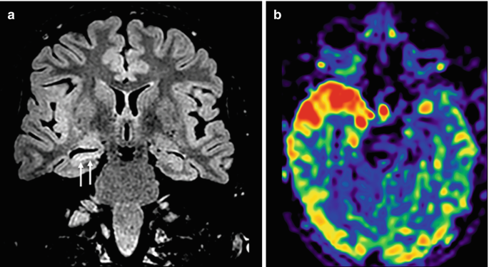 2 parts. a. A coronal F L A I R scan portrays structural changes behind the hippocampus. b. An A S L scan exhibits a patch of blood in a dark shade in the temporal lobe.