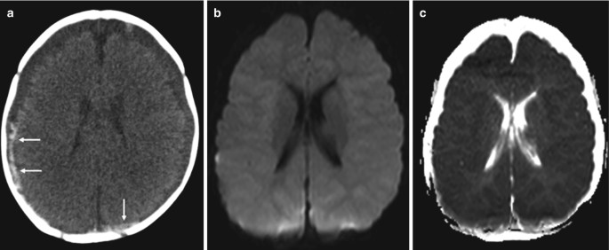 3 parts. a. An axial C T scan of the brain exhibits structural changes. b and c are a M R I scan and a A D C map, which present the swollen brain cells.