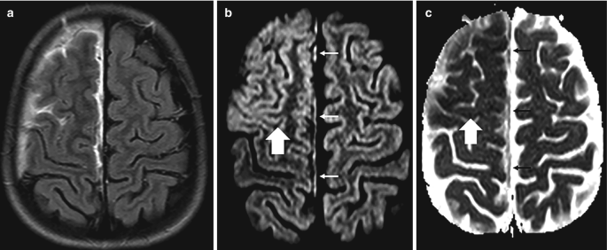 3 parts. a. An axial F L A I R scan exposes the suarachbnid space and arachnoid matter in a light shade. b and c. An axial M R I scan and an A D C map. In the latter, the dura is exposed in the center of both hemispheres.