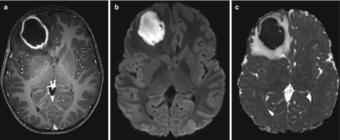 2 axial M R I scans and an A D C map of the brain labeled a to c. A ring-like lesion is exposed in a dark shade in a and c and in a light shade in b, at the top of the left hemisphere.