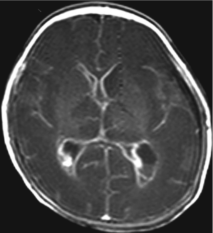 An axial M R I scan of the brain presents the ventricles with prominent light-shaded ependymal cells on their surface.