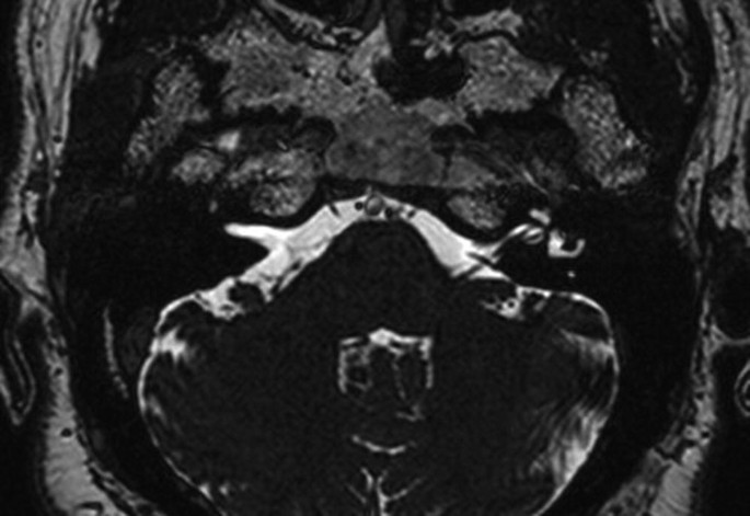 A M R I scan portrays bone formation around the swollen labyrinth.