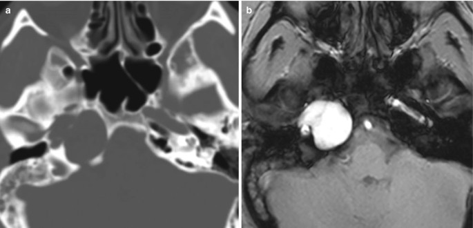 An axial C T and a M R I scan. In the former, the right petrous apex is exhibited in a dark-shaded patch. In the latter, a mass-like lesion is exposed in a light shade.