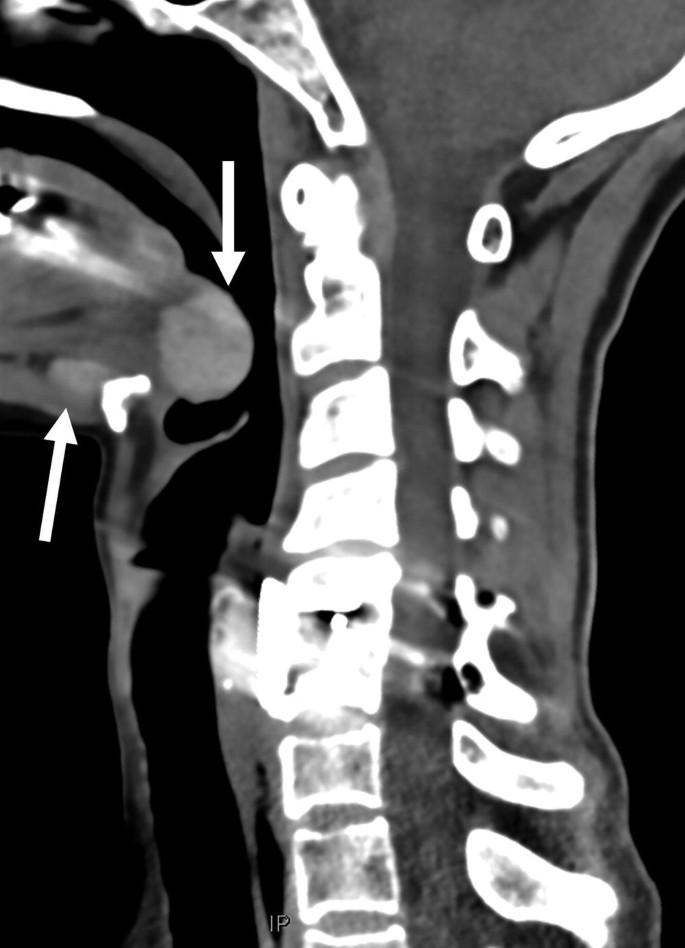 A Contrast-enhanced C T scan of the cervical region with a spherical nodule along the pharyngeal region as indicated by an arrow. A smaller hypodense mass lesion is present in front of the mucosal space.