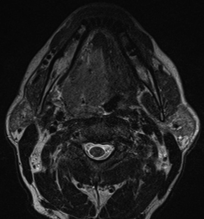 An M R I scan of the head and neck with tumor development to the right tonsils.