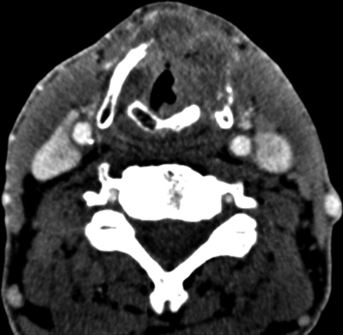 A C T scan of the neck with mass invasion highlighted in the thyroid cartilage.