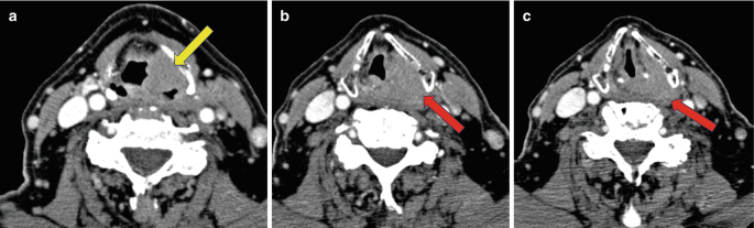 3 C T scans of the neck with sinus squamous cell invasion and tumor position marked on the right.