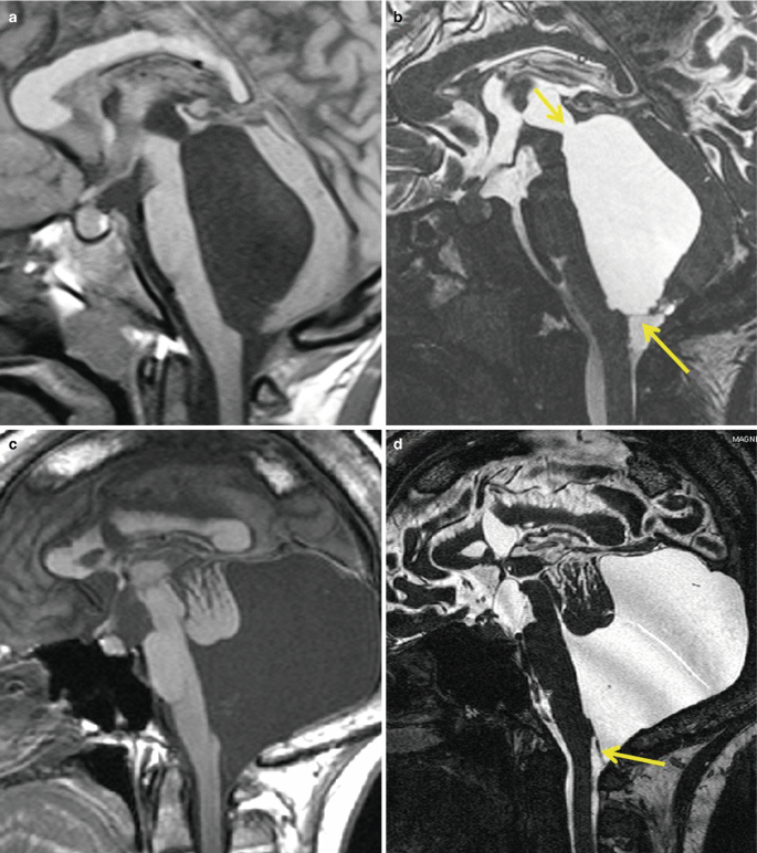 Four 3-D C I S S images and sagittal T 1-weighted images of the brain exhibit the obstruction of the ventricle with an abnormal formation of a cystic lesion that blocks the foramina of Magendie, indicated by arrows.