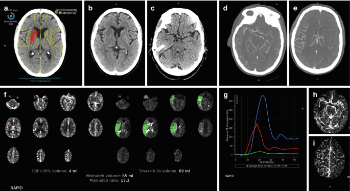 8 sets of radiographs of the brain and a multiline graph are labeled a to i. The hypo, hyper, and iso-dense regions in the scans indicate infarction, thrombus and occlusion, and collateral fillings. F, depicts the core infarct with mismatch volume and ratio. G, plots the change in C T attenuation versus scan time.