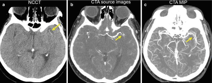 3 scans of the brain. A. The N C C T image exhibits a narrow hyperdense M 2 region on the right lobe indicating a thrombus. B and C are labeled C T A source image and C T A M I P, respectively. Both scans highlight a narrow hyperdense region on the right lobe indicating an occluded vessel.