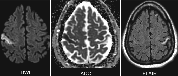 3 scans of the brain. A and B. The D W I and A D C images indicate a hyperintense and dark region on the right post-central gyrus, whereas the FLAIR image in part c exhibits a hyperintense region on the left post-central gyrus.