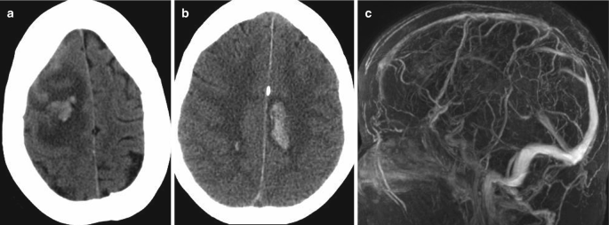 3 scans of the brain. A and B. The N C C T images exhibit a bright opacification surrounded by a hypodense region on the right and left hemispheres, respectively. C. The M R venogram depicts a dilated, bright, blood vessel branch in the superior sagittal sinus.