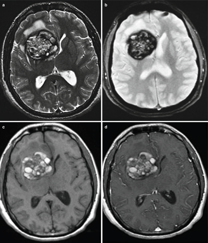4 axial scans of the brain are labeled a to d. The hypo to the hyperintense region with a popcorn-like appearance on the right lobe indicates the presence of a hemorrhagic mass.