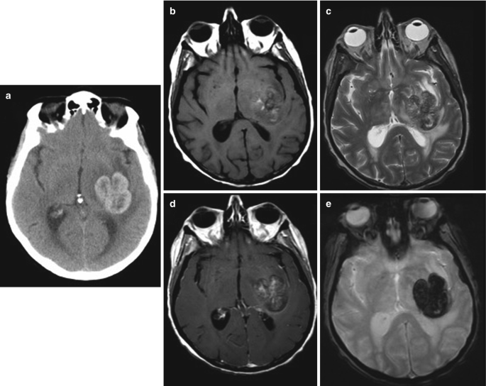 5 axial scans of the brain are labeled a to e. The hypo and hyperintense region on the left basal ganglia indicates the presence of a hemorrhagic mass.