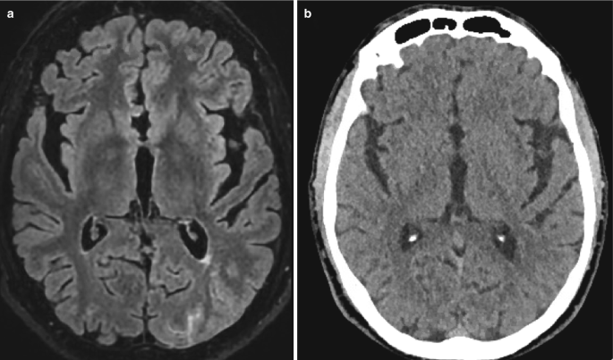 2 scanned images of the brain are labeled a and b. The hyperdense and dark opacities in the brain indicate the presence of subarachnoid hemorrhage.