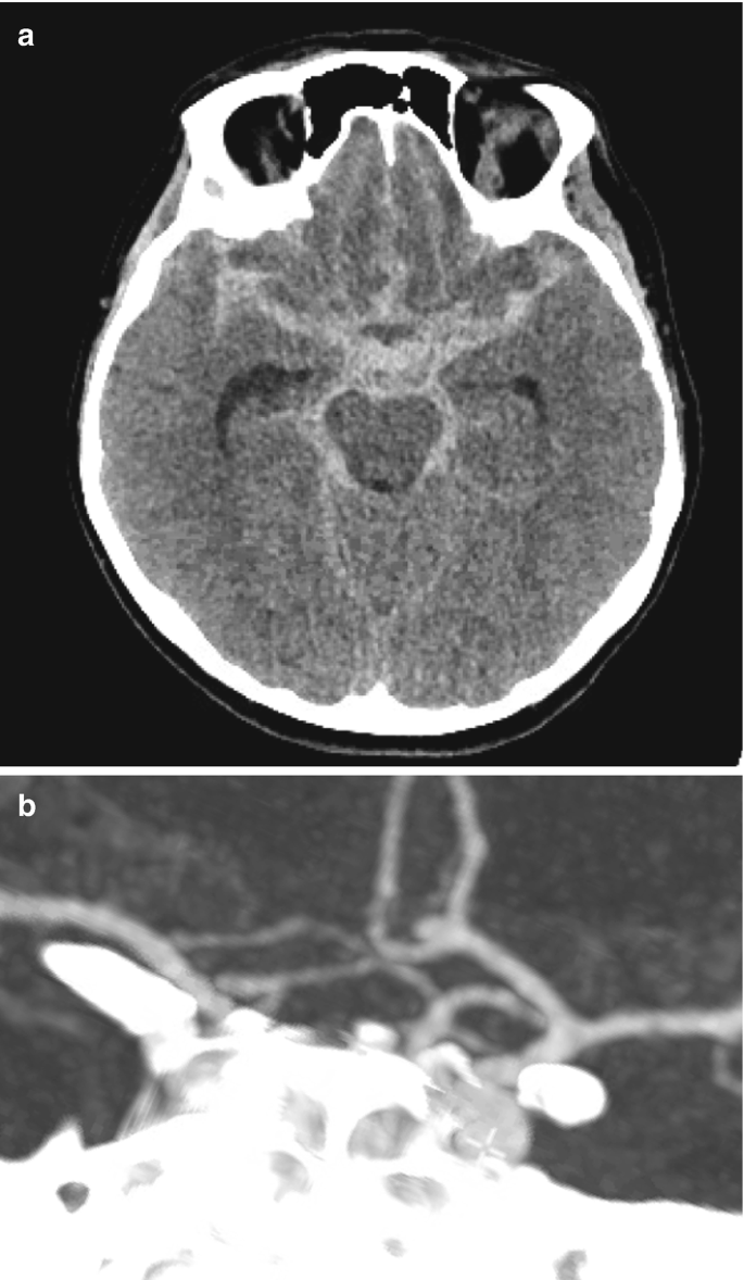 2 scanned images of the brain. A. The hyperdense and a less dense region indicate the presence of subarachnoid hemorrhage and dilated ventricles. B. The large hyperdense region denotes the presence of bleeding in the artery.