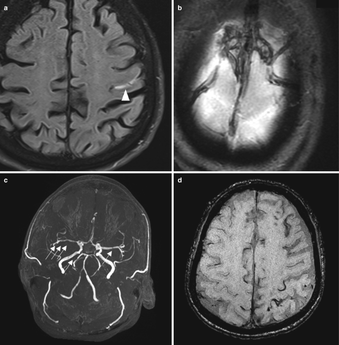 Two M R I, gradient echo, and angio M R scans of the brain are labeled a to d. A. highlights a narrow hyperdense region on the left lobe. B to D. The hyper and hypo-dense regions indicate the presence of thrombosis.