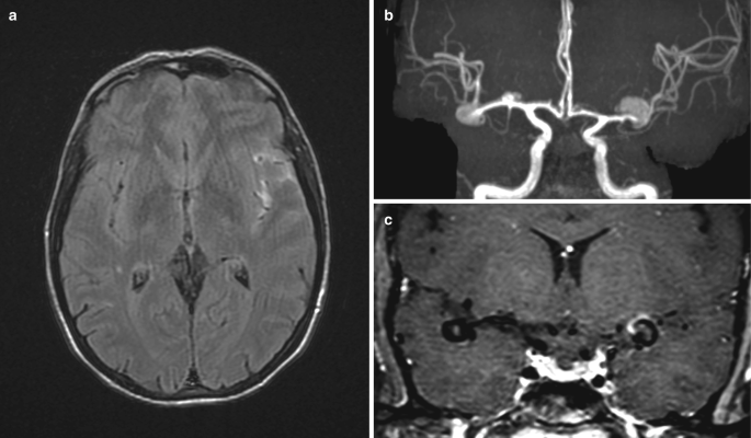 3 scanned images of the brain. A. The hyperdense regions on the left lobe denote hemorrhage. B. The dilated hyperdense blood vessel branches are prominent. C. The coronal scan exhibits hyperintense spots at the center, indicating the presence of a ruptured aneurysm.