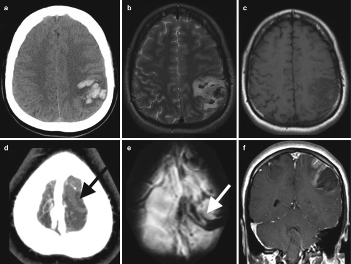 5 axial scans, a to e, and a coronal scan, f, display the brain. A to E. The hyperdense, less dense, and dark opacities on the parietal region of the left lobe indicate the presence of hematoma and thrombosis. F. A round-shaped dark region on the right lobe denotes the gyriform enhancement.