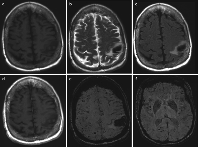 6 axial scans of the brain are labeled a to f. An oval-shaped isodense and hypodense region at the left parietal lobe indicates the presence of hematoma.