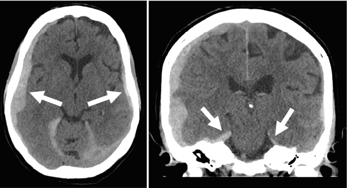 2 C T scans of the brain. Left. Arrows point to a crescent-shaped, less-dense region under the dura mater on the temporal lobes of both sides, indicating the hematoma. Right. The arrows highlight the less dense region on both sides of the pons.