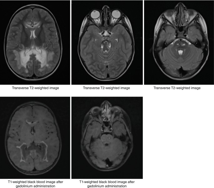 5 axial scans of the brain. Top. 3 transverse T 2 weighted scans exhibit a large bright region at the biparietal, and bright patches at the center, respectively. Bottom. 2 T 1 weighted black blood images after gadolinium administration depict less dense regions at the center.