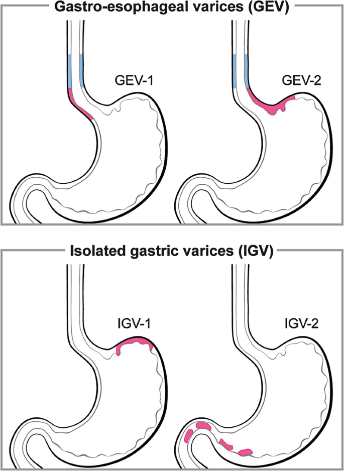 Balloon-occluded Transvenous Obliteration For Gastric Varices 