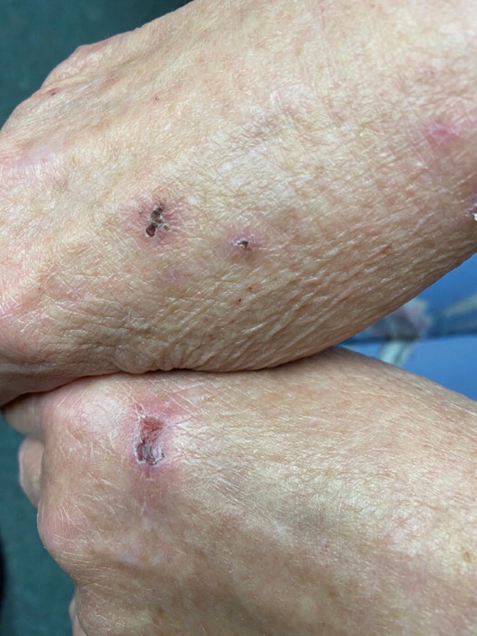Excoriating Rash Geriatric Psychocutaneous Disorders | Springer Nature Link