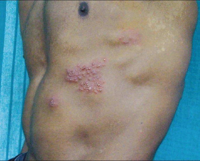 2. Shingles (Herpes Zoster)
