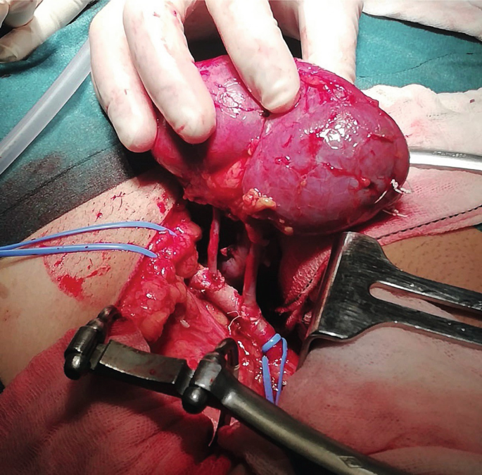 Renal Transplantation Surgical Aspects | Kidney Disease | kidney | Failure | Causes | Diagnosis | Treatment | Homeopathic | Allopathic | Dr Qaisar Ahmed MD, DHMS