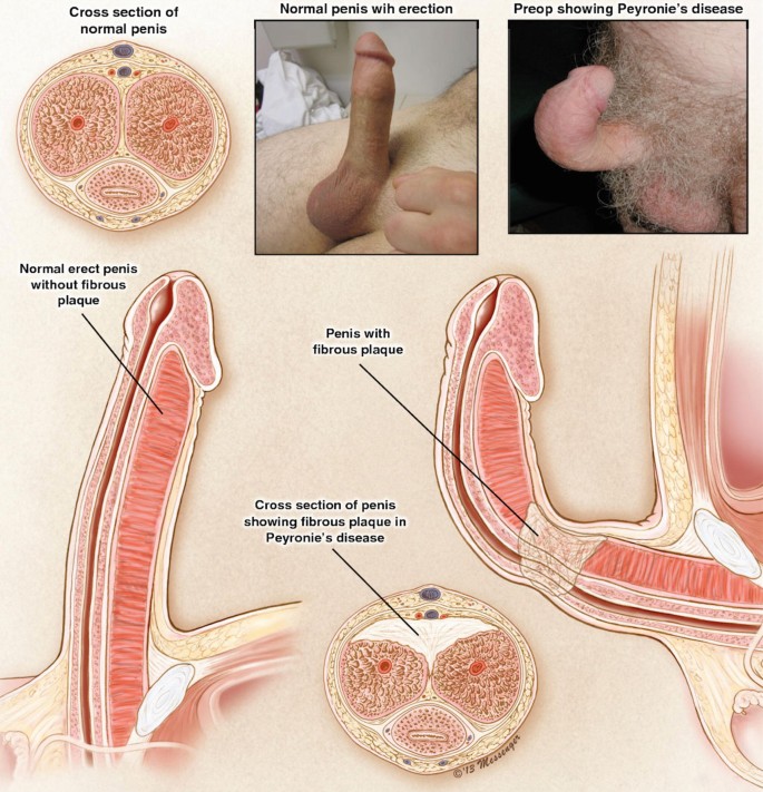 l acetyl carnitine penis girth L-Carnitine for Erectile Dysfunction: What the Evidence Shows and Practical Considerations Erectile Dysfunction and Curved Penis: