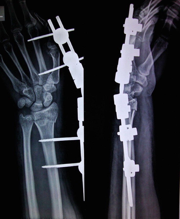 Two X-ray images present the external and internal fixation of the broken bone of the human hand.
