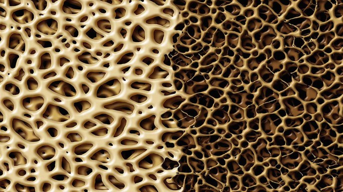 A micrograph exhibits the reduction in bone mass density in an osteoporosis patient.