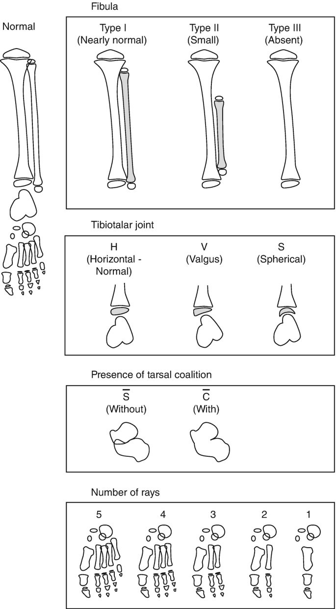 Hybrid ACL reconstruction in a 6-year-old female with fibular hemimelia -  Patrick G Tate, Edward M Wojtys, 2019, image size:685x1240
