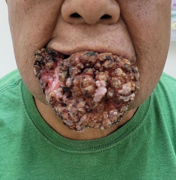 A photograph of a patient with a large oral tumor. The mass arises from the right inner cheek and the lower lip.