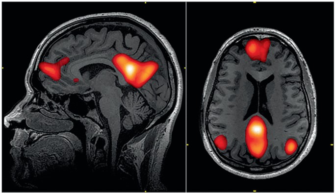 A sagittal and axial view of a human brain on the left and right. Left, two bright spots are visible on the frontal and parietal lobes. Right, The bright spots are located in the frontal lobes, both left and right sides, and toward the back of the brain.