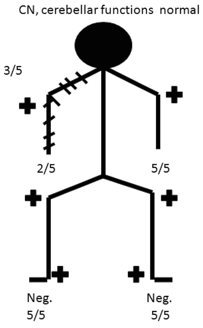 Waxing and Waning Hand Weakness SpringerLink