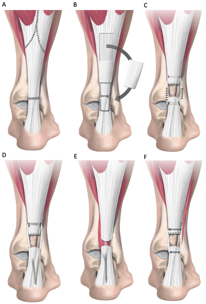 Chronic Achilles Tendon Rupture | Springer Nature Link
